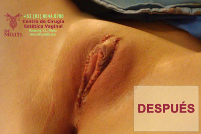 vaginoplastia06_desp